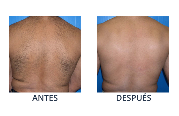 fotodepilacion opiniones